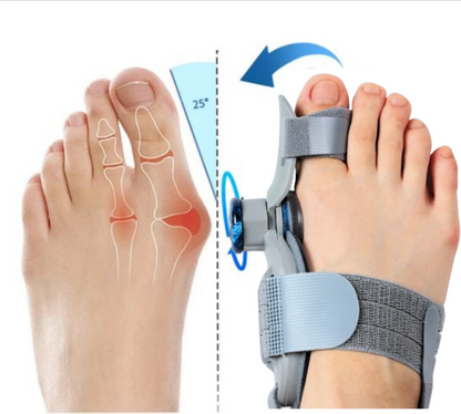 PODIAFIX™ - Correcteur Orthopédique Avancé pour Hallux Valgus [ Convient pour les deux pieds ]